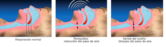 apnea del sueño causas