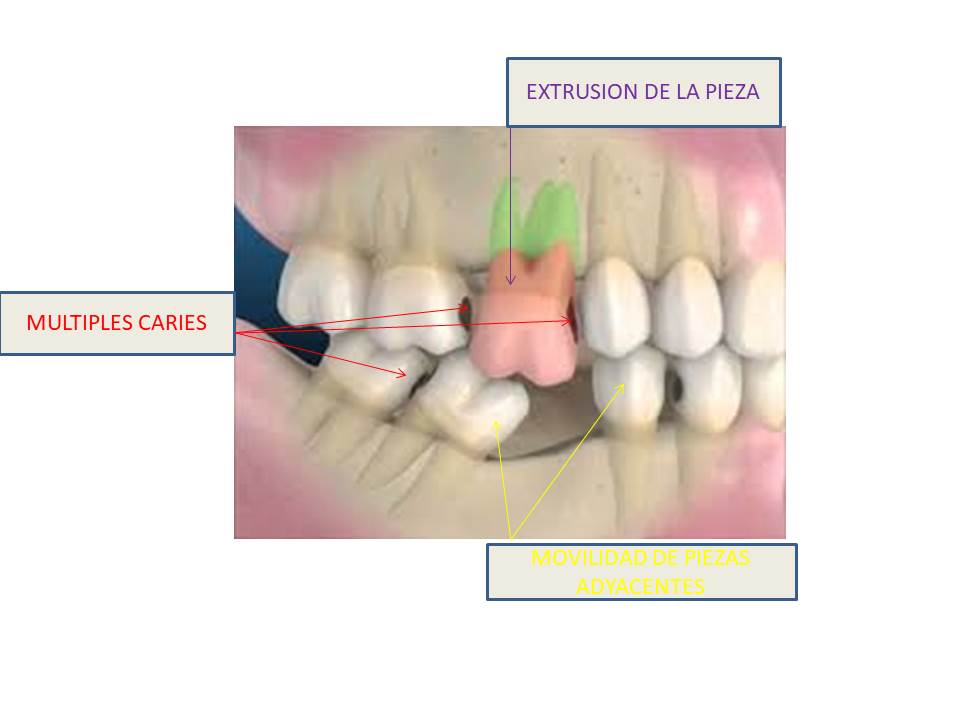cirugia dental barrero
