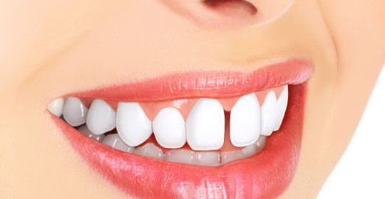diastema