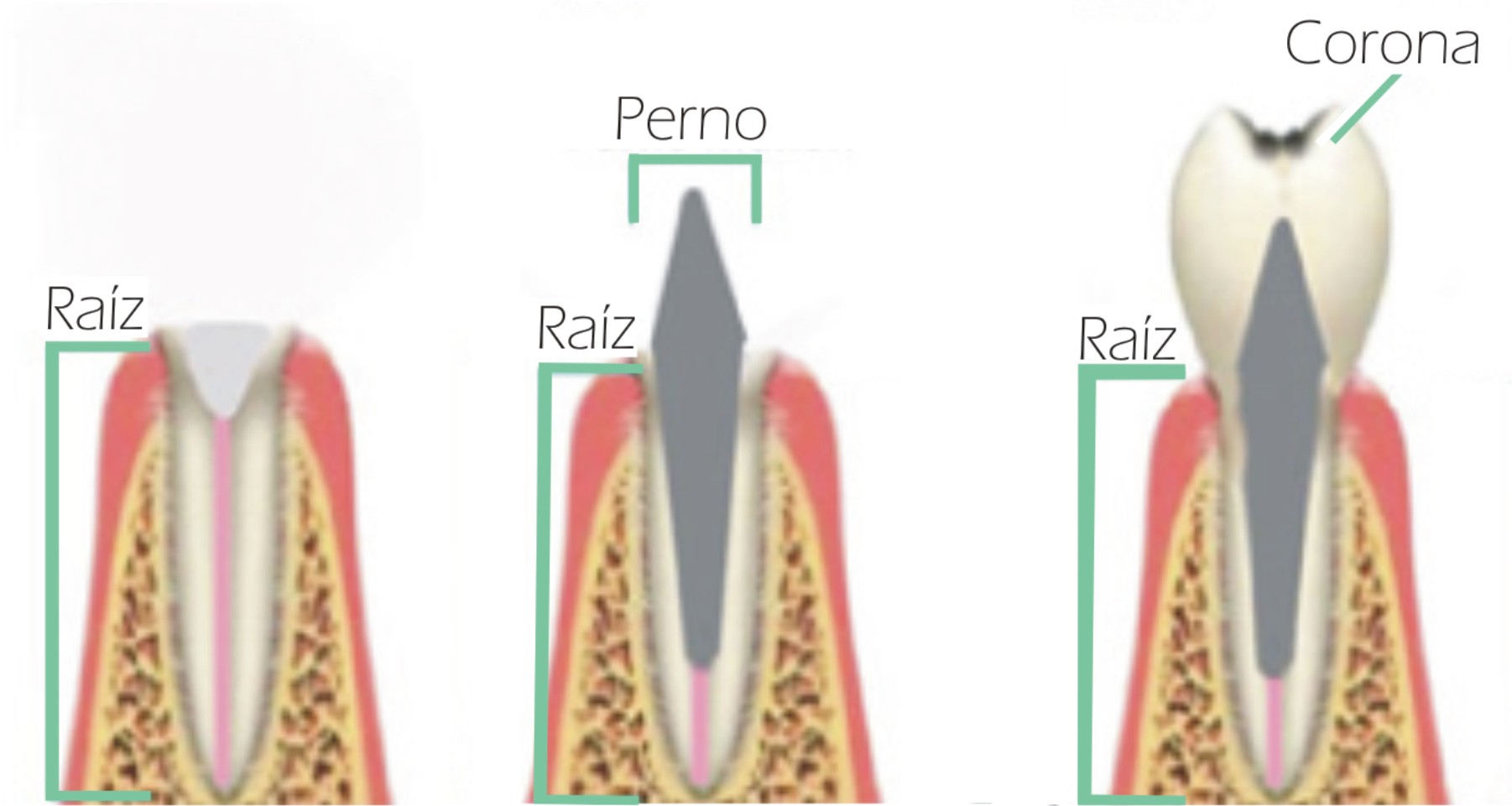 endodoncia corona