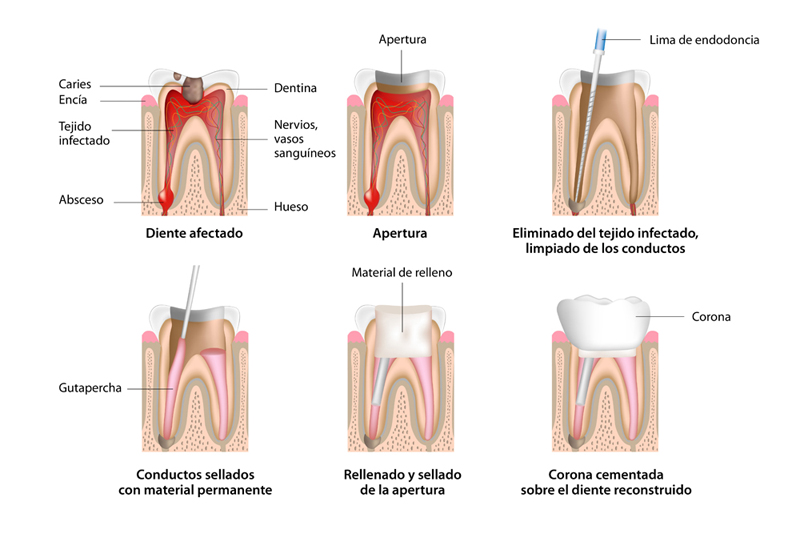 como se hace una endodoncia