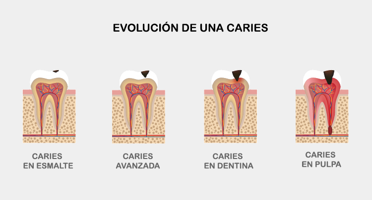 evolucion de la caries