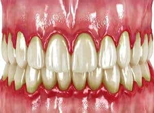 gingivitis