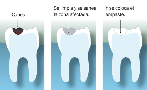 que es un empaste dental