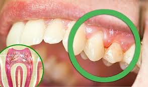 periodoncia