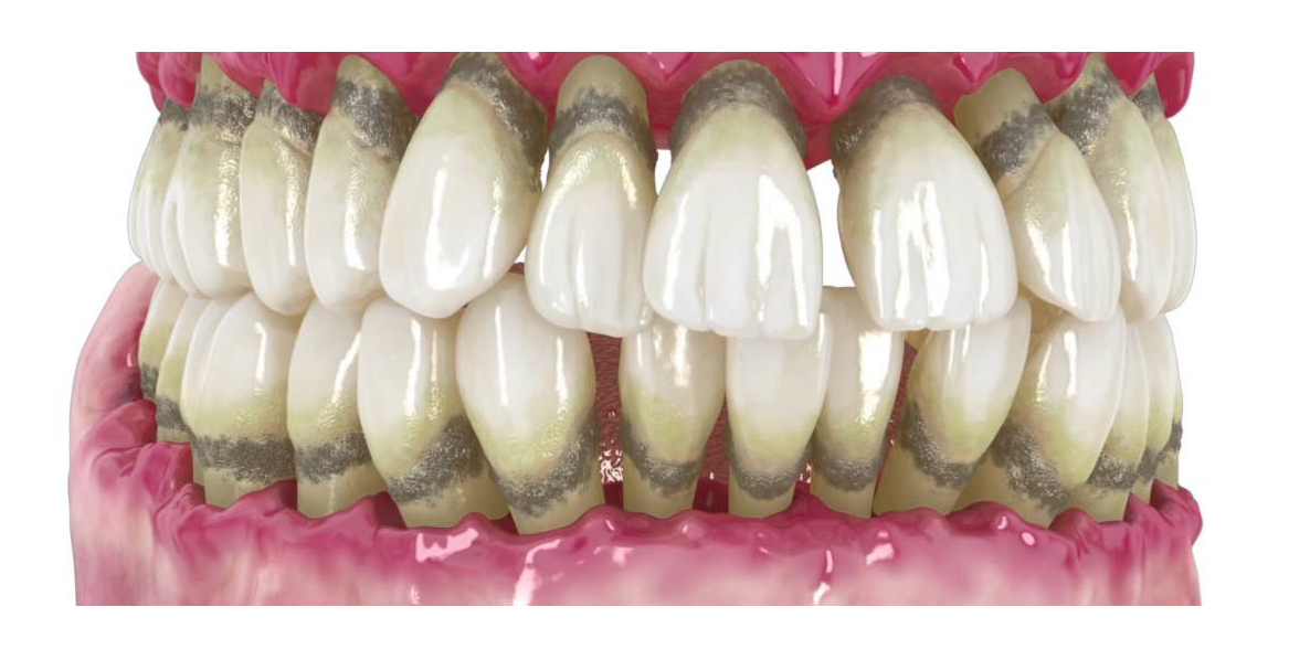 periodontitis