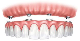 protesis completa sobre implantes