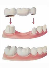 protesis fija sobre dientes