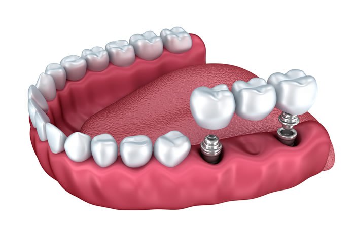 protesis fija sobre implantes