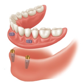 protesis implanto soportada (removible)