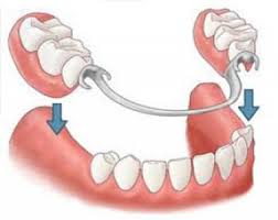 protesis parcial removible